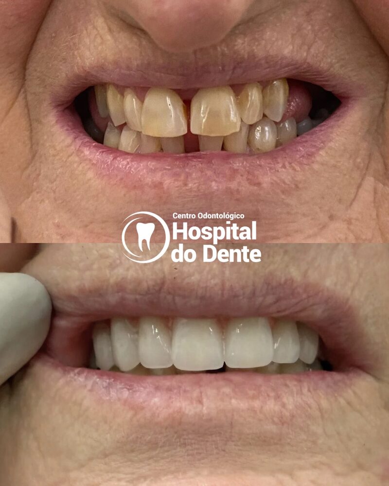 Antes e depois de reabilitação estética com facetas e coroas no Hospital do Dente