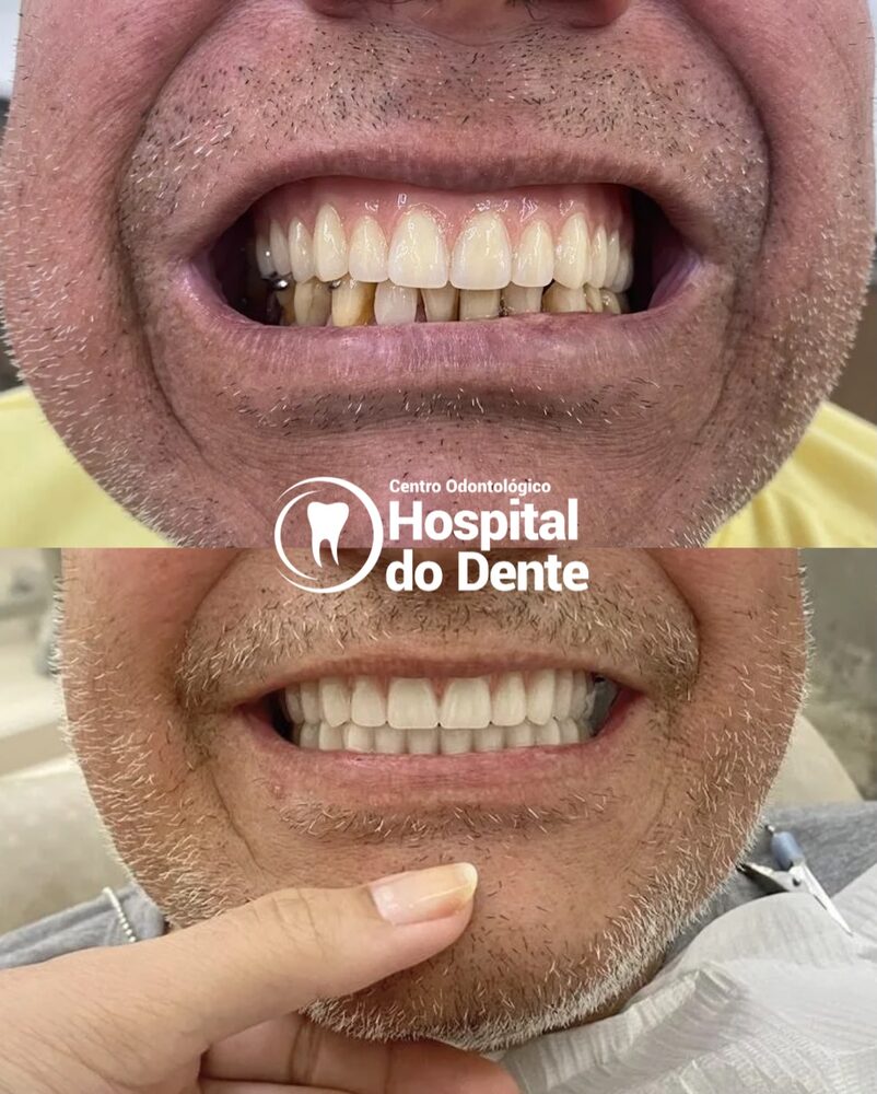 Antes e depois de prótese fixa sobre implantes no Hospital do Dente em Campos Novos